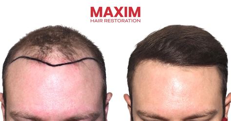 MAXIM HAIR RESTORATION .